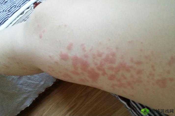 淑娟两腿间又痒了引发的不适状况
